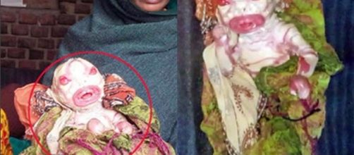 Doen&ccedil;a rara faz crian&ccedil;a nascer deformada