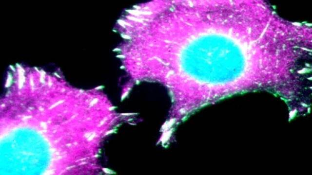 Tumore al seno, nuovi passi avanti alla lotta al cancro