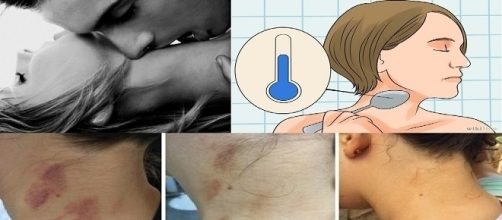 Truques podem ajudar pessoas a ficarem livres das manchas de chup&otilde;es