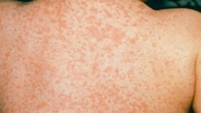 Eruzione cutanea tipica da morbillo, particolarmente contagiosa.