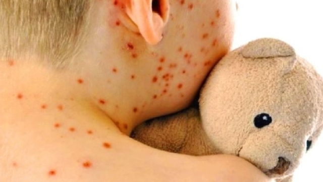 Allarme morbillo in Italia, a Pescara &egrave; epidemia 25 casi. Colpito ... - fanpage.it