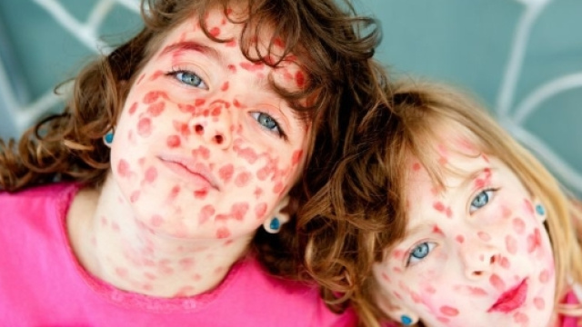 Morbillo: un virus di cui si pu&ograve; morire - Il Tuo Benessere - iltuo-benessere.com