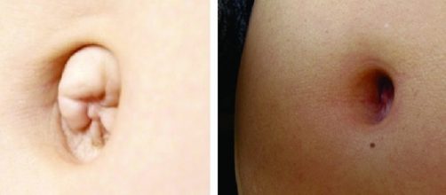 Saiba a diferen&ccedil;a de se ter o umbigo projetado ou profundo