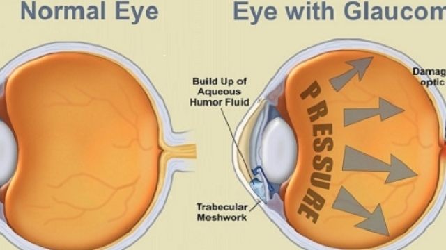 Una diagnosi precoce di glaucoma pu&ograve; salvare la vista.