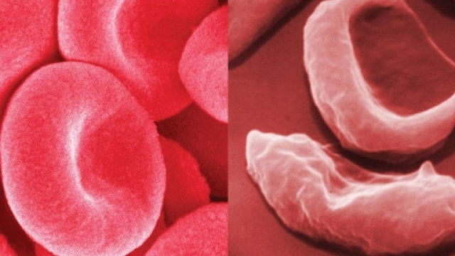 Anemia falciforme, ragazzo guarito grazie a terapia genica - healthclinicweb.com