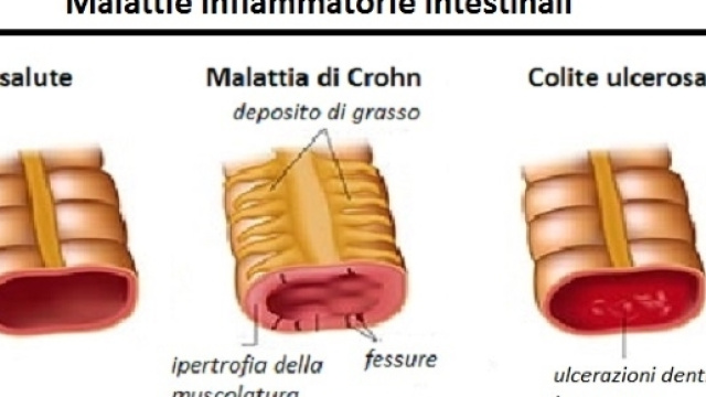 In presenza di infiammazioni intestinali croniche, l&rsquo;alimentazione ha un ruolo importante