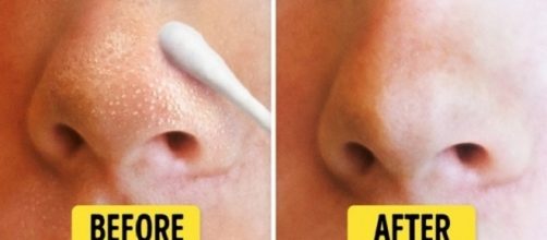 Como se livrar de cravos e espinhas em algumas semanas - Bright Side