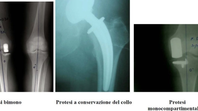 La sostituzione articolare, protesi di ginocchio, protesi d'anca ... - norbertoconfalonieri.com