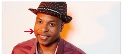 Cantor Buchecha mostrou resultado ap&oacute;s cirurgia nas bochechas