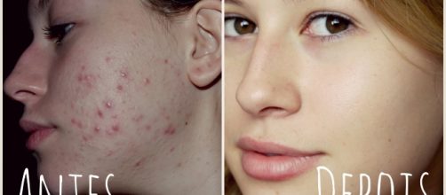 Remova todas as espinhas usando apenas um ingrediente