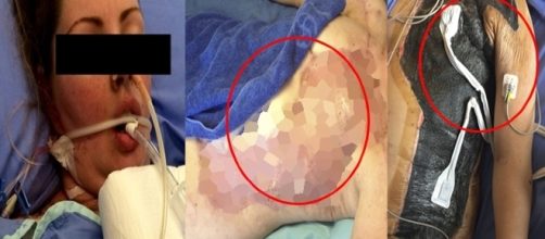 Lesley no hospital, ap&oacute;s sofrer com uma bacteria mortal