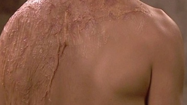 la schiena di Damian Dos Casas &egrave; piena di cicatrici