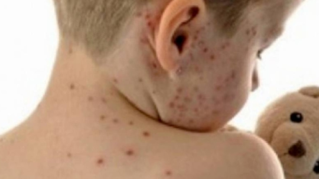 Aumentano i casi di morbillo in Italia