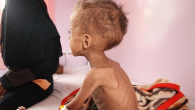Yemen, 432mila casi di bambini malnutriti a causa della guerra e della carestia