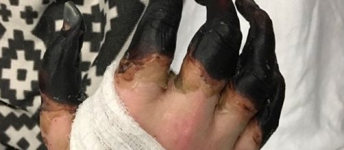 Na imagem os membros do homem j&aacute; necrosados pela infec&ccedil;&atilde;o, e a ponto de serem amputados.