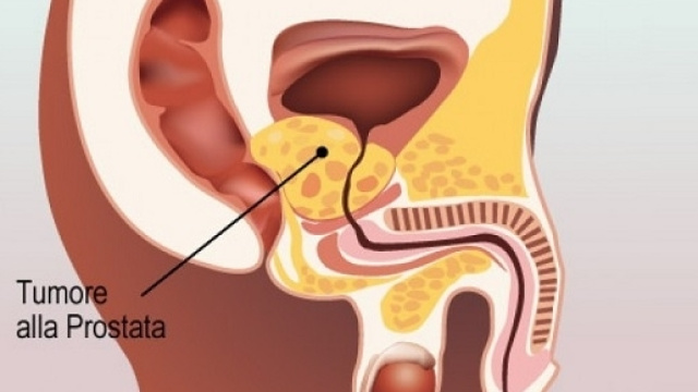 Le nuove linee guida limitano molto il dosaggio del PSA come metodo di screening del tumore alla prostata.