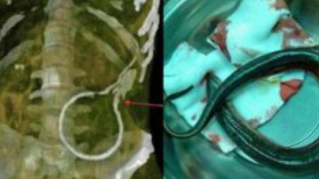 Uomo ricoverato con una anguilla nell'ano