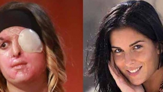 A sinistra Gessica Notaro dopo essere stata sfregiata con l'acido