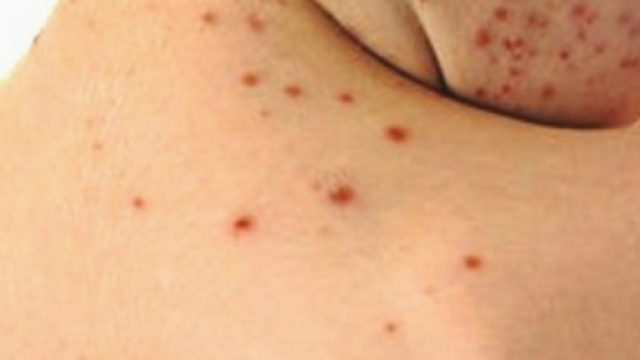 Boom di morbillo in Italia: +230% nei primi mesi del 2017 - Wired - wired.it