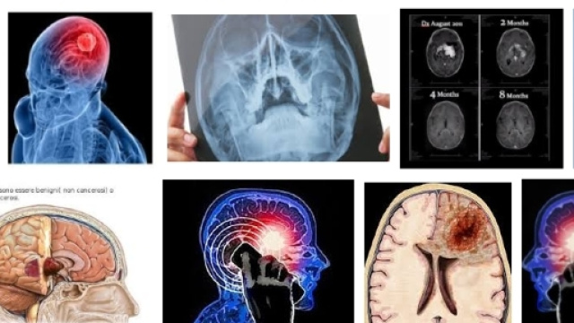 cancro al cervello e cellulare