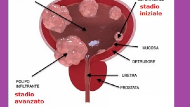 La vescica con la formazione di tumori, comunemente chiamati polipi, da uno stadio iniziale fino ad uno stadio avanzato.