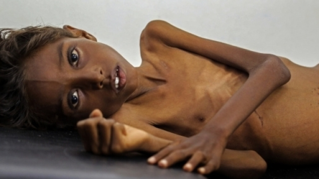 Enfant malnutri au Y&eacute;men, Huffingtonpost