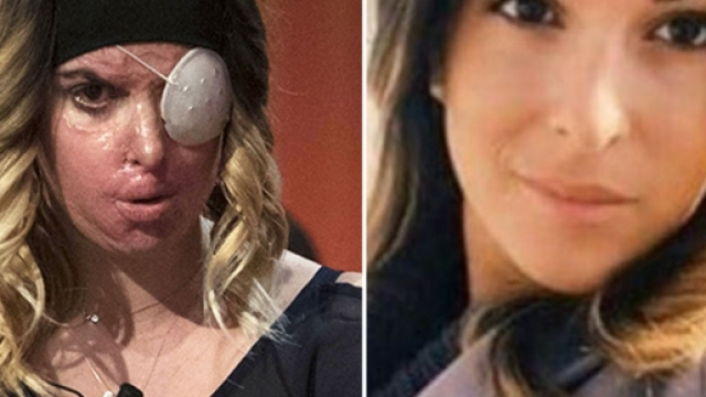 Former beauty queen Gessica Notaro reveals acid attack scars on ... - com.au