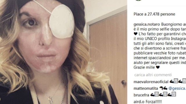 Il nuovo account Instagram di Gessica Notaro sfregiata dall'ex fidanzat &egrave; un modo per accettare la realt&agrave; e tornare a vivere