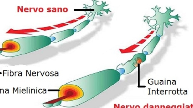 Individuata la base genetica predisponente verso malattie autoimmuni come la sclerosi multipla