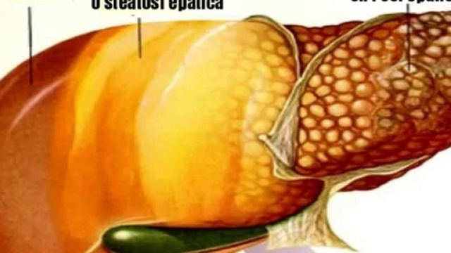 FEGATO GRASSO, ECCO LA SOLUZIONE - lanozione.com