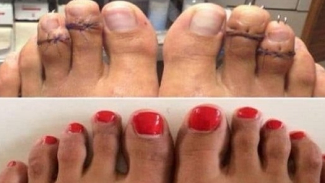 La chirurgie Cendrillon pour raccourcir les pieds devient tr&egrave;s tendance aux Etats-Unis