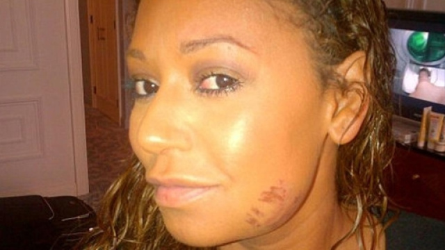 Mel B in tweet del 2012 mostra i segni delle percosse subite dal marito (Credits: NY Daily News)