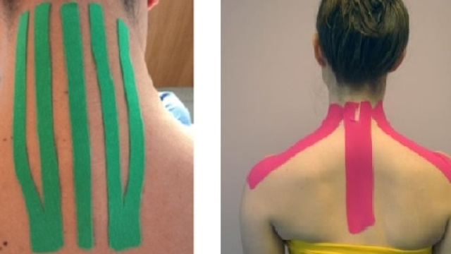 L&rsquo;applicazione di cerotti elasticizzati pu&ograve; alleviare i dolori da sindrome dolorosa miofasciale cervicale.