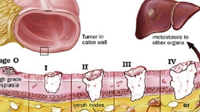 Dal 1 gennaio 2018 verr&agrave; introdotto una nuova classificazione dei tumori, che andr&agrave; a sostituire l&rsquo;attuale basata sul sistema TNM.