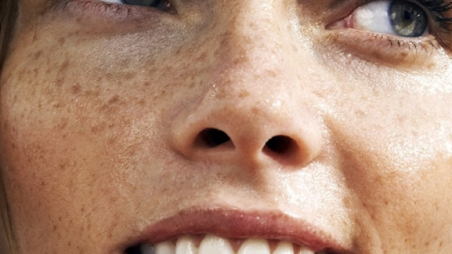 Ecco cosa significano quelle macchie solari sul viso