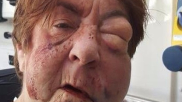 Colpita con mazza da baseball per debiti di droga del figlio