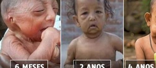 Com apenas quatro anos, este garotinho de Bangladesh foi apelidado de &ldquo;Benjamin Button&rdquo; (Foto: Google)