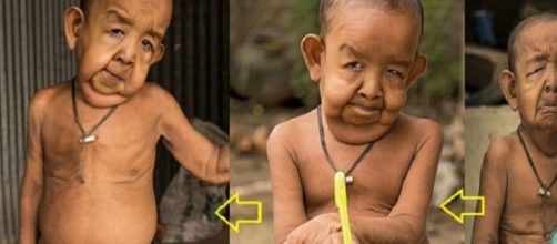 Com uma doen&ccedil;a rara, ele &eacute; conhecido como 'Benjamin Button', personagem da fic&ccedil;&atilde;o que tem a inspira&ccedil;&atilde;o na mesma doen&ccedil;a.