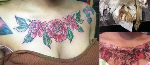 Remo&ccedil;&atilde;o de tatuagem deixa fortes marcas