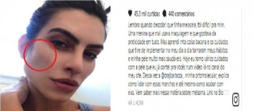 Atriz contou sobre tratamento de doen&ccedil;a na pele (Foto: Montagem/ Google)