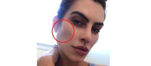 Saiba tudo sobre a doen&ccedil;a de Cleo Pires