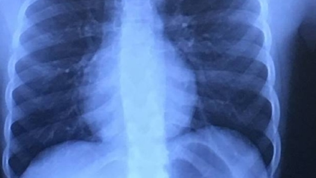 Un dischetto del Fidget spinner staccatosi dal gioco, ingoiato, &egrave; finito nell'esofago di una bimba di 10 anni costretta a un'intervento chirurgico.