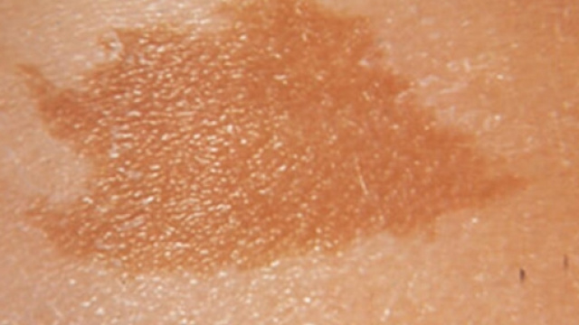 Quattro tumori sul corpo per la neurofibromatosi: la vita difficile di Koren