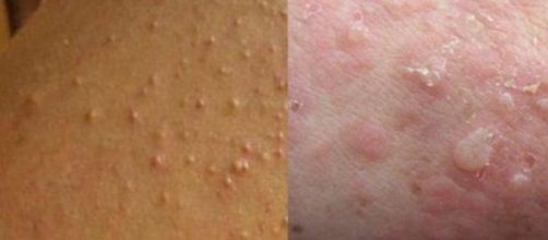 Essas bolinhas, &agrave;s vezes, s&atilde;o um inc&ocirc;modo. Saiba o motivo delas surgirem nos bra&ccedil;os