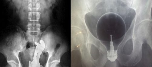 Objetos estranhos encontrados em raio-X