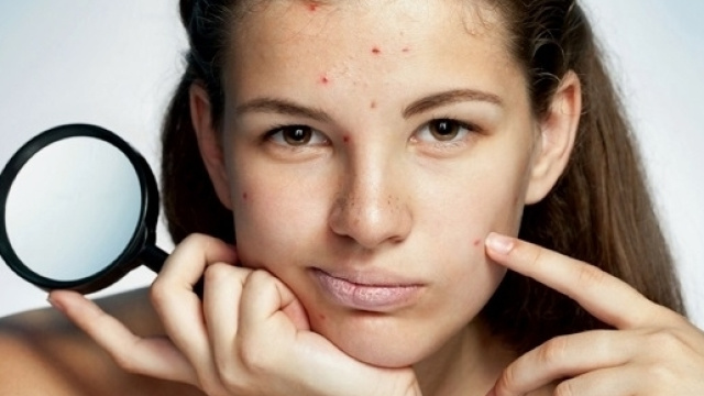 Dieta corretta, probiotici e estratti naturali riducono le lesioni dell'acne.