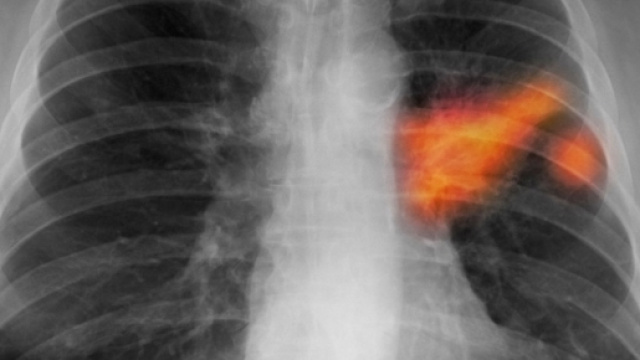 Tumore al polmone: nuova speranza per i non operabili.