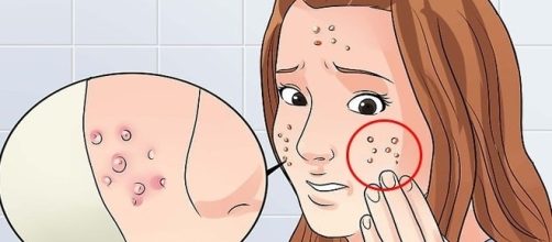 Apesar de inc&ocirc;modo, a acne &eacute; uma rea&ccedil;&atilde;o natural do nosso corpo