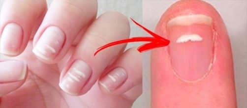 Fique atento &agrave;s manchas brancas nas unhas