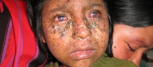 Xeroderma Pigmentosum, ou S&iacute;ndrome do Vampiro.